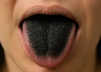 Weight loss jab leads to black tongue and health crisis for bride-to-be