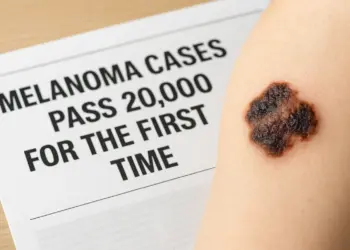 Melanoma diagnoses reach record high in the UK