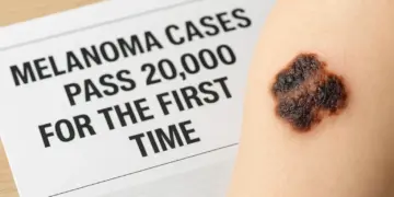 Melanoma diagnoses reach record high in the UK
