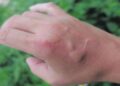 Man's spider bite leads to near-fatal health crisis and lifestyle transformation