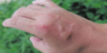 Man's spider bite leads to near-fatal health crisis and lifestyle transformation