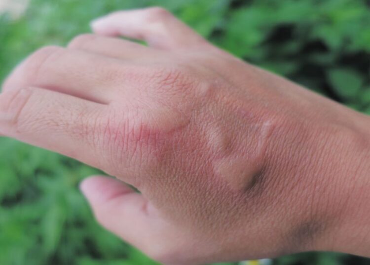 Man's spider bite leads to near-fatal health crisis and lifestyle transformation